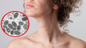 virus del mono